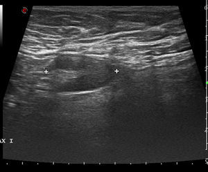 Afectación difusa del parénquima mamario, sin límites ni nódulos definidos, observándose un aumento en la vascularización y una adenopatía con engrosamiento cortical difuso de 2,3cm.