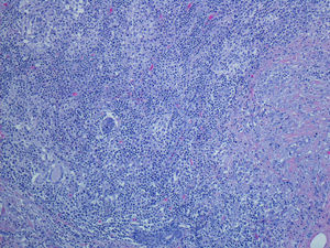 Inflamación linfohistiocitaria periférica con células gigantes multinucleadas; HE ×100.