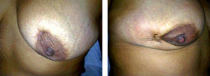 Estado actual de las mamas tras cirugía.