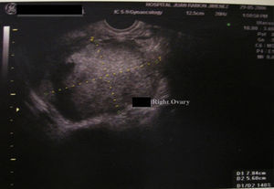 Imagen ecográfica: imagen de ecos heterogéneos, bordes mal definidos de 7,81cm x 5,60cm de ovario derecho.