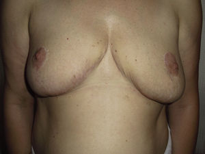 Resultado tras reducción mamaria de más de 1.500g en cada mama.