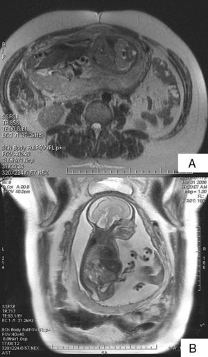A) Imagen axial de resonancia fetal, single-shot fast spin echo (SSFSE) potenciada en T2: se observan riñones en herradura y arteria umbilical única en el feto. B) Imagen coronal de resonancia fetal, SSFSE potenciada en T2: la imagen muestra hiperlordosis lumbar fetal.