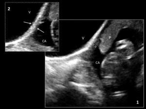 Ecografía 2D en la semana 24. Medida del grosor del segmento uterino inferior con sonda abdominal. Grosor máximo 2mm (1). Detalle del segmento (flechas) (2). V: vejiga; CA: cavidad amniótica; P: placenta.