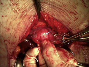 Estado del segmento inferior durante la cesárea. Con la maniobra del cirujano puede verse, por transparencia, el guante.
