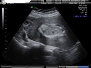 La imagen ecográfica muestra masa placentaria retenida intraútero posparto. Corte transversal.
