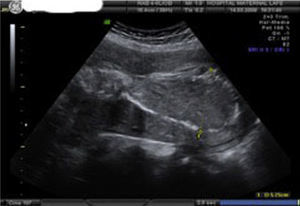 La imagen ecográifca muestra masa placentaria retenida intraútero posparto con grosor máximo de 5,25cm. Corte longitudinal.
