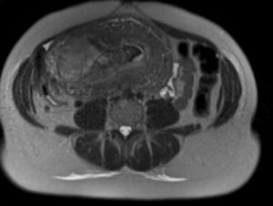 La imagen de resonancia magnética muestra la invasión placentaria del miometrio.