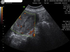 La ecografía en modo Power-Doppler muestra la cavidad uterina vacía tras la expulsión de la masa placentaria y ausencia completa de vascularización.