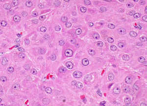 Las células presentaban un citoplasma amplio, eosinófilo, ligeramente granular. Los núcleos eran grandes, de carioteca lisa, con un único nucléolo prominente. (HE ×60).