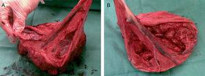 A y B Placenta, donde puede observarse inserción velamentosa del cordón.