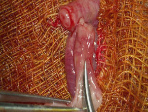 Sección completa antimesentérica del segmento uterino, aislado para el autotrasplante.