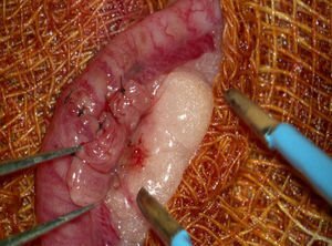 Desvascularización del fragmento uterino con coagulación bipolar tras finalizar el autotrasplante.