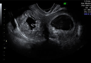 Fotos del embarazo ectópico cervical.