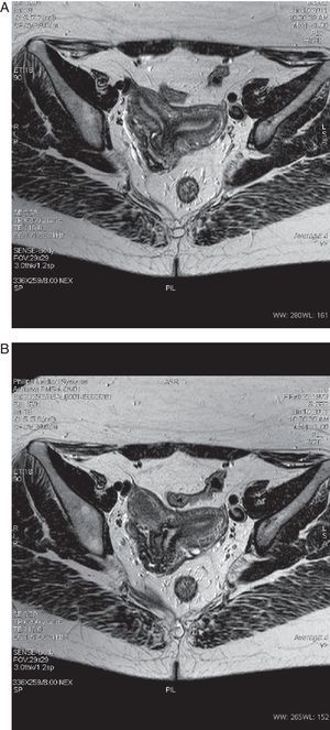 RM pélvica. A) Útero bicorne bicollis (duplicación de cuerpo uterino donde se observan dos cavidades endometriales). B) RM pélvica: útero bicorne bicollis (se demuestra comunicación intrauterina).