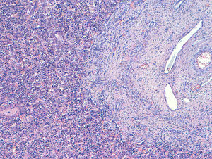 Fibrosis portal diagnosticada (imagen microscópica) en el primer feto.