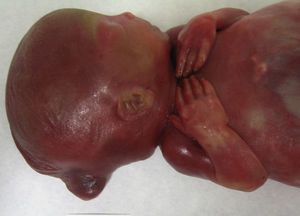 Meningocele occipital y pabellones auriculares de implantación baja observados en el segundo feto.