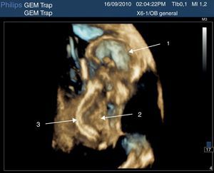 La imagen sagital del feto acardias muestra estructuras craneales (1), estructuras cardiacas (2) y columna vertebral (3). Imágenes tomadas con sonda 6-1 Mhz matrix (Philips Ultrasound).