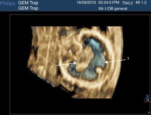 Holoprosencefalia alobar en el feto acardias: ventrículo único (1) y saco dorsal posterior (2). Imágenes tomadas con sonda 6-1 Mhz matrix (Philips Ultrasound).