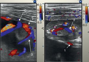 A) El Doppler color muestra el flujo de cordón en el gemelo vivo a nivel de inserción placentaria (1), la anastomosis arterio-arterial entre ambas circulaciones (2) y flujo de retorno hacia el gemelo acardias (3). B) Doppler color en el feto acardias: entra a través de arteria umbilical (1) y dibuja el territorio vascular arterial (2).