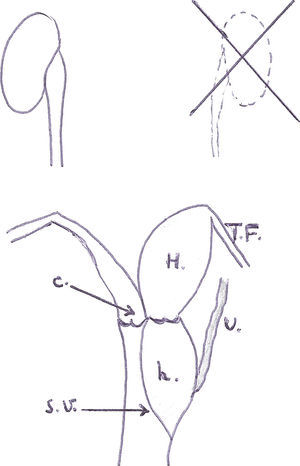 Útero didelfo, hemivagina obstruida y aplasia renal ipsilateral. Representación esquemática de la anomalía. TF: trompas de Falopio; h: hematocolpos; H: hematometra; C: cérvix uterino; U: uréter ectópico; SV: hemivagina ciega y septo vaginal.