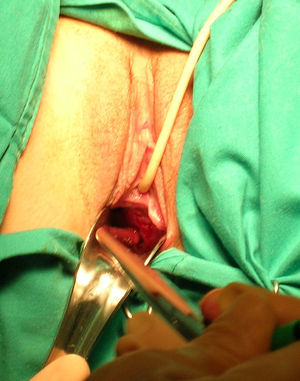 Útero didelfo, hemivagina obstruida y aplasia renal ipsilateral. Hallazgos operatorios. Hemivagina ciega con septo vaginal obstructivo.