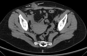 TC pélvica con contraste por vía intravenosa de la paciente de la figura 1. Lesión nodular (entre flechas) de densidad similar al tejido blando con realce periférico tras la administración del contraste por vía intravenosa, con zonas hipodensas en su interior, situada en el tejido subcutáneo bajo la cicatriz de la cesárea.