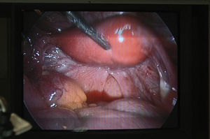 Visión laparoscópica del útero doble.