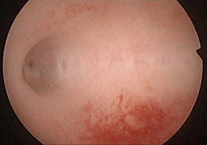 Imagen histeroscópica a los 5 meses de la cesárea. Cavidad uterina normal.