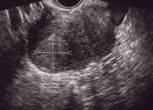 Ecografía a los 21 días poscesárea. Imagen nodular cornual derecha, bien delimitada de 30×36mm sin mapa color a 3mm de la serosa uterina.