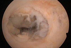 Imagen histeroscópica a los 47 días poscesárea. Seudocavidad en cuerno uterino derecho de 1,5-2cm.