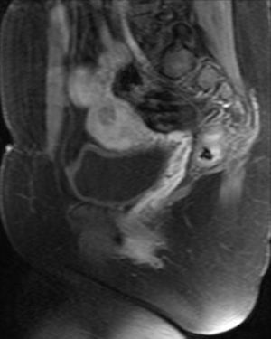 Resonancia magnética a los 4 meses. Corte sagital. Imagen nodular intramural de 15mm, hipointensa, mal delimitada en cuerno uterino derecho, avascular en contacto con la cavidad endometrial y separada de la serosa.