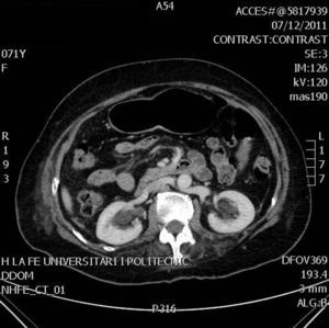 TC abdomino-pélvica con contraste. Se observa una hematoma de aproximadamente 15×17cm de diámetro en el área de Retzius.