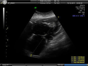 Visualización ecográfica por vía abdominal del hematoma a los 13 días de la intervención, con un volumen calculado de 765cm3, ocupando la mayor parte del hemiabdomen inferior.