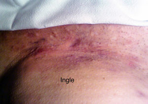 Hidrosadenitis inguinal con cicatrices.