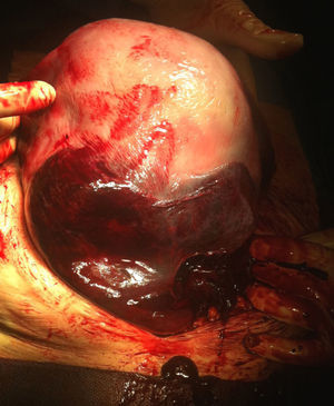 Rotura uterina.