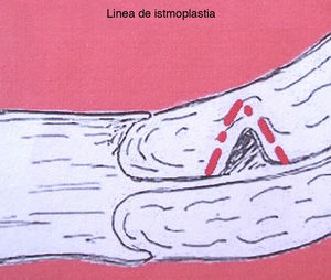 Representación esquemática del istmocele.