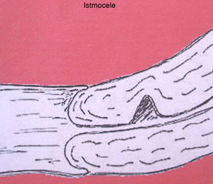 Línea de incisión de la istmoplastia.