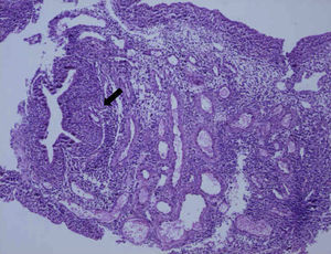 En el estudio anatomopatológico de la pieza se objetiva a la izquierda de la imagen un foco indicativo de endometriosis (flecha). (Tinción hematoxilina-eosina, 10X).