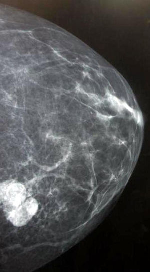 Mamografía cráneo-caudal de mama izquierda.