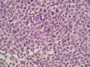 Infiltración del parénquima mamario por células epitelioides con pleomorfismo e hipercromatismo nuclear y mitosis. (Hematoxilina-eosina, ×200).