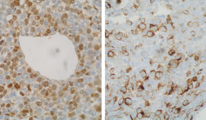 Izquierda: inmunotinción positiva nuclear y citoplasmática para la proteína S-100 en las células infiltrantes mamarias. (proteína S-100, ×400). Derecha: inmunotinción positiva en el citoplasmática para HMB-45 en las células infiltrantes mamarias. (HMB-45, ×400).