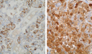 Izquierda: inmunotinción positiva citoplasmática para HMB-45 en las células infiltrantes ováricas. (HMB-45, ×400). Derecha: inmunotinción positiva citoplasmática y nuclear para la proteína S-100 en las células infiltrantes ováricas. (Proteína S-100, ×400).