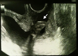 Ecografía transvaginal al ingreso de la paciente. Bolsa amniótica prolapsada en el canal cervical, con pie del primer feto en su interior.