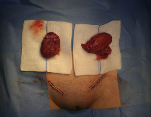 Piezas quirúrgicas. Aspecto macroscópico de las gónadas masculinas extraídas de ambos conductos inguinales durante la orquiectomía.