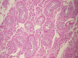 Aspecto microscópico de las gónadas: hiperplasia de células de Leydig en el intersticio, con atrofia tubular, engrosamiento de la membrana basal y atrofia espermatogénica con células de Sertoli.