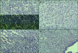 Tinción con hematoxilina-eosina, en la que se pueden observar: distribución perivascular (A), células claras (B), células fusiformes (C) y células epitelioides (D).