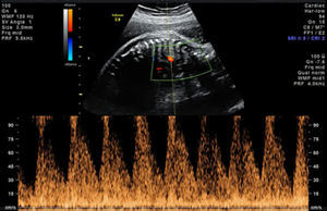 Imagen Doppler que muestra un flujo diastólico elevado a través del conducto arterioso en el caso 1.