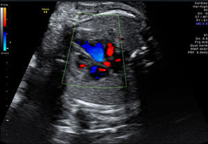 Ecocardiografía fetal mostrando hipertrofia del ventrículo derecho en el caso 2.