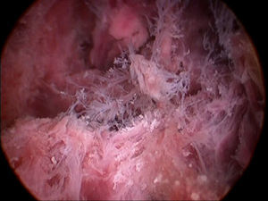 Detalle del pólipo placentario observándose las microvellosidades.