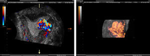 Detalle de la ecografía 3D de la hipervascularización que presenta el pólipo placentario.